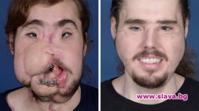 Мъж с трансплантирано лице: Отново мога да се усмихна